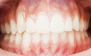 欧米人の歯のイメージ